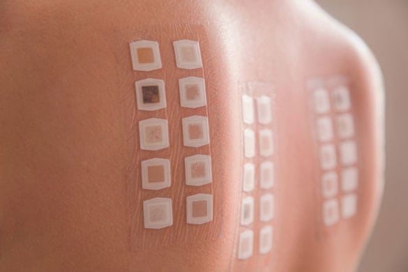 Allergy-Skin-Patch-Test