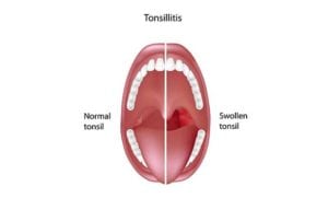 Tonsillitis-Diagram
