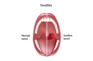 Tonsillitis-Los-Angeles-ENT-Doctors
