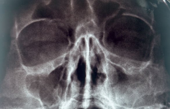 X-Ray-of-Sinuses