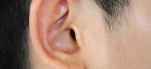 patient-after-ear-reduction-LA-ENT-Doctor